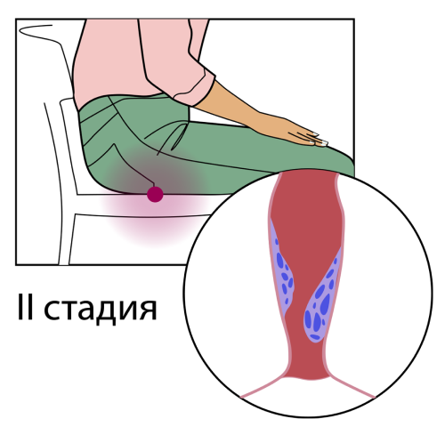 2 стадия