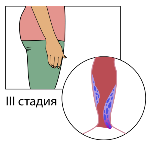 3 стадия