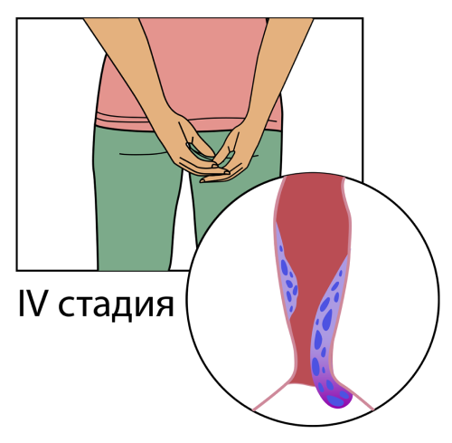 4 стадия